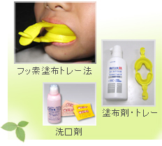 小児歯科 予防-フッ素塗布
