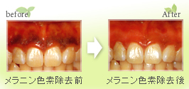 レーザー治療による歯ぐきの（黒ずみ）メラニン色素除去