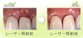 レーザー治療による歯周病（歯槽膿漏）治療
